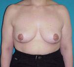 Patient # 85591 After Photo # 2
